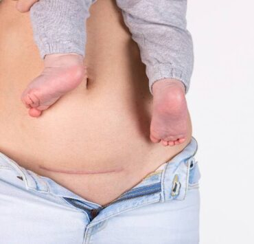 brzuch kobiety po cesarskim cięciu z blizną