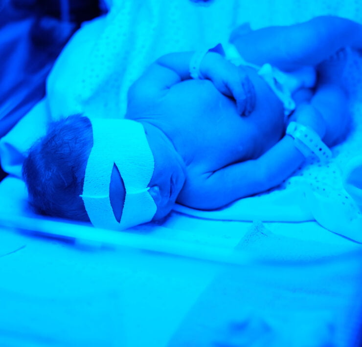 noworodek naświetlany z powodu żółtaczki fizjologicznej
