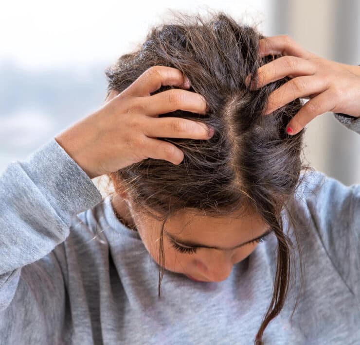 młoda dziewczyna z łupieżem