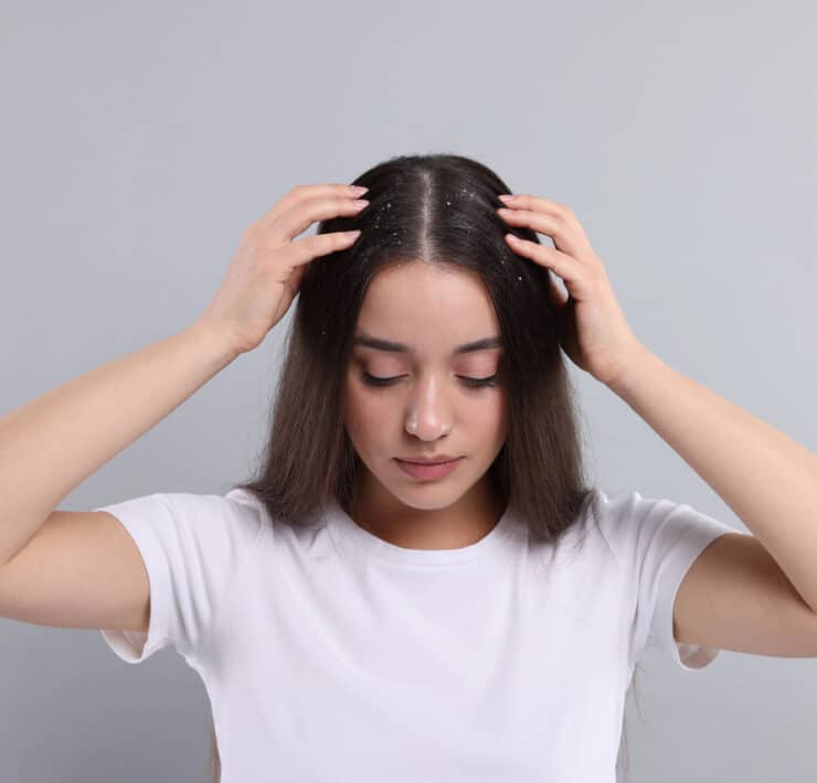 Nastolatka z łupieżem