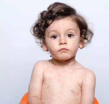 choroby z wysypką dziecko z wysypką