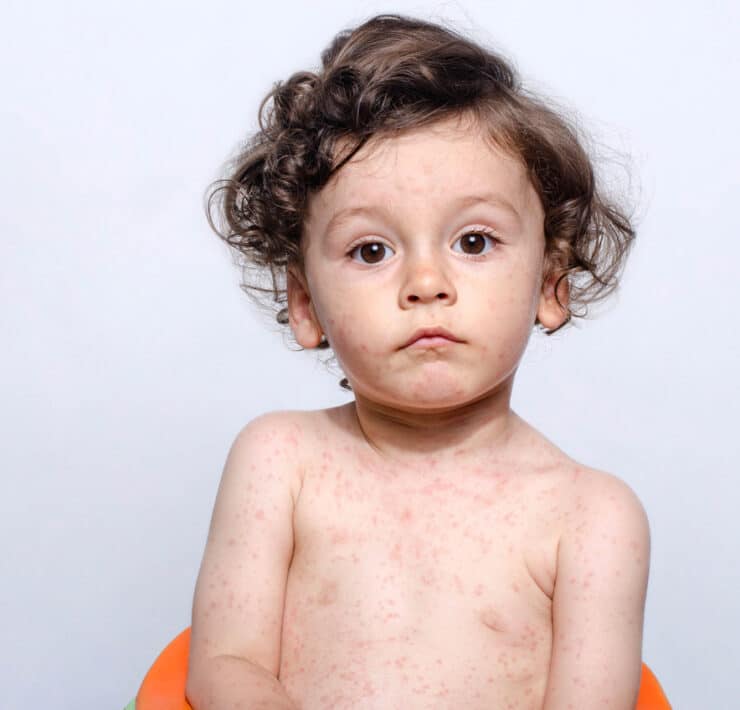 choroby z wysypką dziecko z wysypką